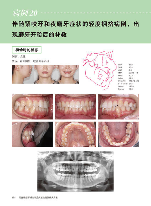 无托槽隐形矫治常见失败病例及解决方案 赵建鑫 廖文主译 矫正失败知识经验整理各类问题解决技巧9787559135896辽宁科学技术出版社 商品图4