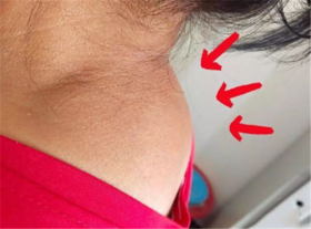  体内有血栓，肩膀先知？肩膀出现“5”个症状，你可能就中招了！ 