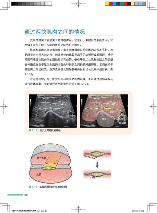 超声引导下周围神经阻滞技巧图解 附视频 仲西康显著 张锦 李涛主译 超声扫查技巧 穿刺阻滞方法 北京科学技术出版社9787571437329 商品图3