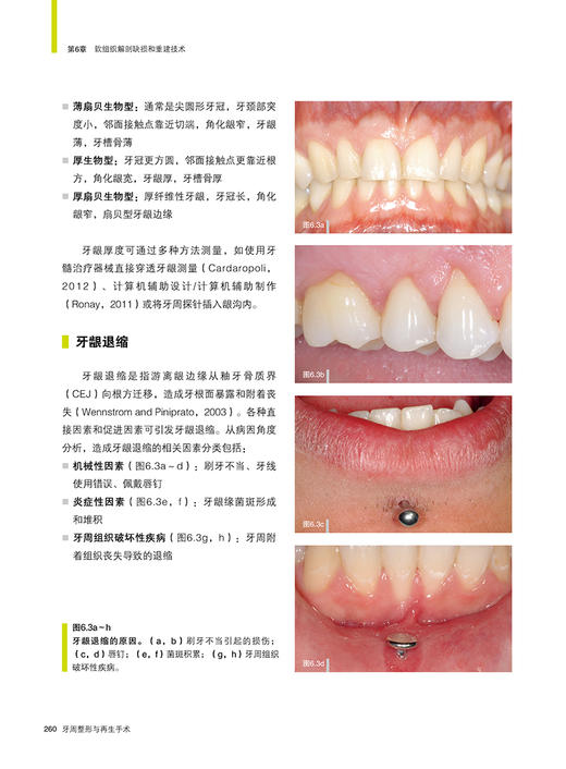 牙周整形与再生手术 潘亚萍主译 口腔牙周病病理发病机制诊断治疗感染控制 手术操作细节技巧详解9787559134219辽宁科学技术出版社 商品图3