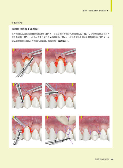 牙周整形与再生手术 潘亚萍主译 口腔牙周病病理发病机制诊断治疗感染控制 手术操作细节技巧详解9787559134219辽宁科学技术出版社 商品图4