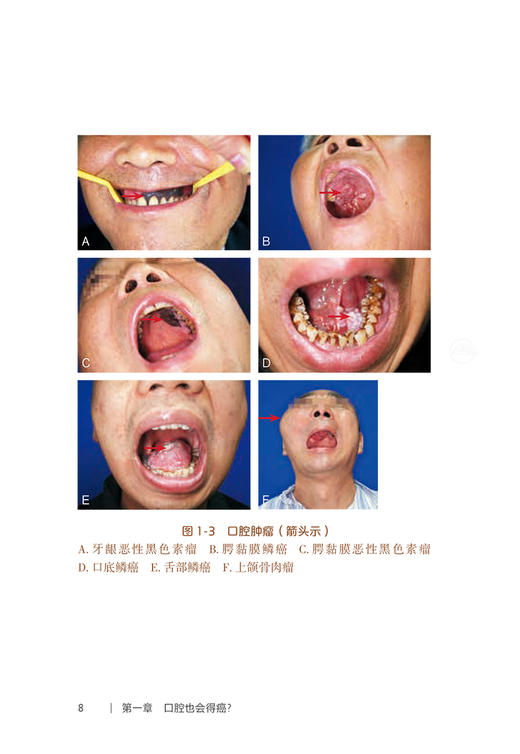 口腔自我保健视频漫画丛书 口腔肿瘤篇 附视频 张陈平 口腔肿瘤基本知识科学预防诊治保健护理方法 人民卫生出版社9787117363693 商品图3