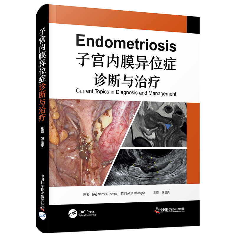 子宫内膜异位症诊断与治疗