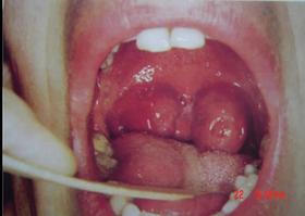  扁桃体反复发炎，腺样体肥大到底切不切？专家：这种情况必须做 