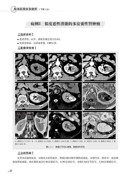 腹部影像征象解析 下册 贾云生等主编 深入理解腹部影像学 涵盖了解刨结构和疾病变化 常见和罕见腹部影像征象 9787523513552 商品图4