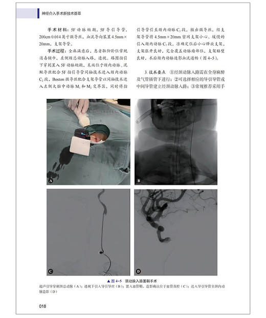 神经介入手术新技术荟萃 刘赫 汪阳 脑血管内手术基础知识技术操作细节 医学生及临床医师参考书 中国科学技术出版社9787523608128 商品图4