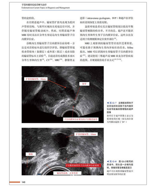 子宫内膜异位症诊断与治疗 张信美主译 子宫内膜异位症临床特点延迟诊断治疗 超声检查磁共振成像9787523606216中国科学技术出版社 商品图3