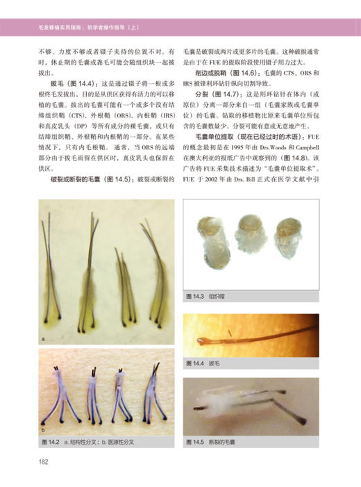 毛发移植实用指南 初学者操作指导上 附视频 毛发移植操作讲解 制定长期治疗及手术计划方法 辽宁科学技术出版社9787559135483 商品图3