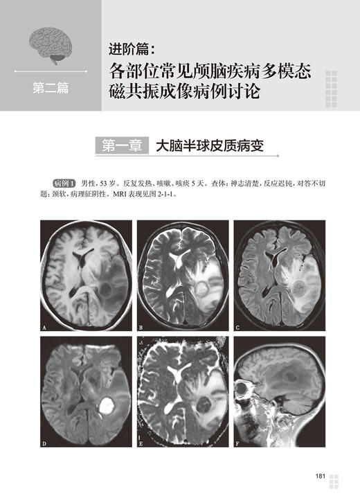 颅脑疾病多模态磁共振成像诊断思路及案例解析 曹代荣 李坚 邢振 常见颅脑疾病多模态磁共振成像典型病例分析 9787117360777 商品图2