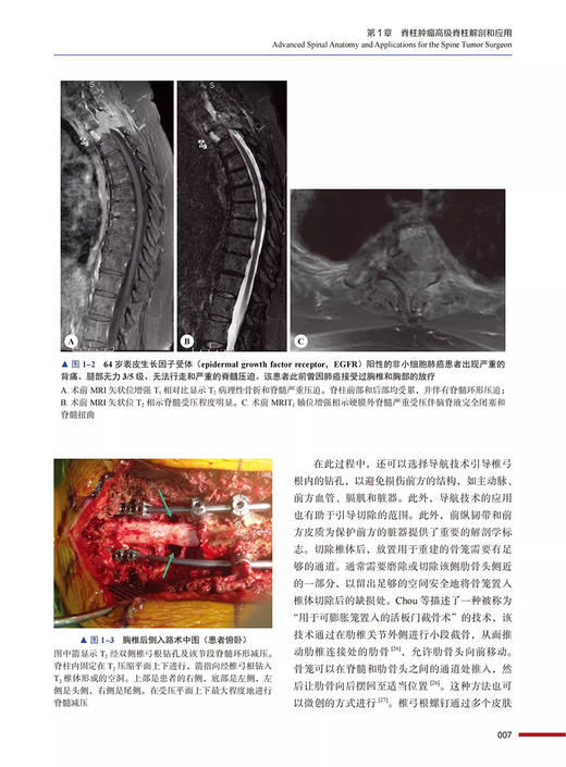 脊柱肿瘤外科学 现代多学科策略 高延征 廖文胜 主译 经典骨科学译著 可作为住院医师和入门脊柱外科医师指导书 9787523606186 商品图4