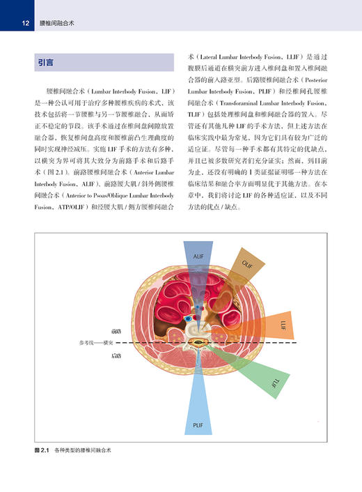 腰椎间融合术 萨蒂什鲁德拉帕主编 梅伟 王庆德主译 脊柱外科 骨科手术 外科手术技巧 辽宁科学技术出版社9787559133854 商品图4