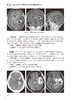 颅脑疾病多模态磁共振成像诊断思路及案例解析 曹代荣 李坚 邢振 常见颅脑疾病多模态磁共振成像典型病例分析 9787117360777 商品缩略图3