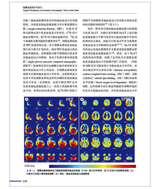 烟雾血管病手术技巧 陈劲草 章剑剑 主译 烟雾血管病手术方法要领技巧实用指南 典型病例分析 中国科学技术出版社9787523606124 商品图3