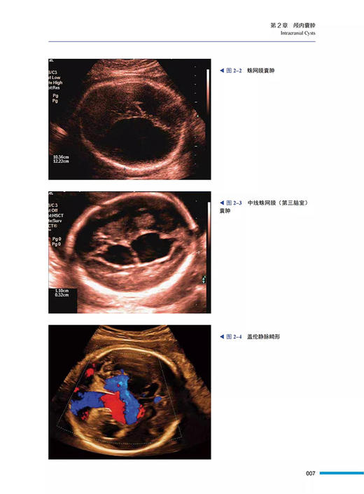 产科超声 基于胎儿异常的诊断思路 原书第2版 吴青青 等译 适合母胎医学 产科学 超声医学专业医生及医学生参考阅读 9787523606285 商品图4
