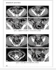 结直肠癌免疫治疗学 临床诊疗思维 丁培荣 结直肠癌临床诊治经典案例 免疫治疗不良反应处理指导 中国科学技术出版社9787523606308 商品缩略图4