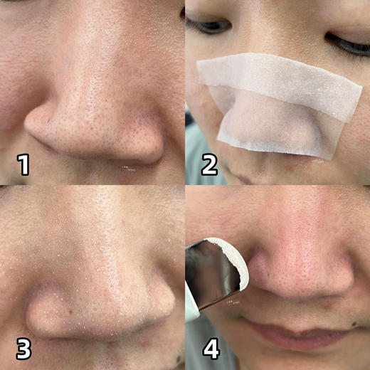 赠品翻倍升级！超好用！去黑头太绝了！ilso导出液黑头水150ml 商品图10