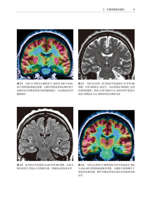 癫痫影像病例图解 田树平 卢强 范淼 癫痫PET/MR及MR诊断治疗疗效评估 临床病例影像诊断图谱影像表现9787117365116人民卫生出版社 商品图4