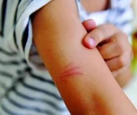  动物抓伤咬伤，先别着急用创可贴！ 