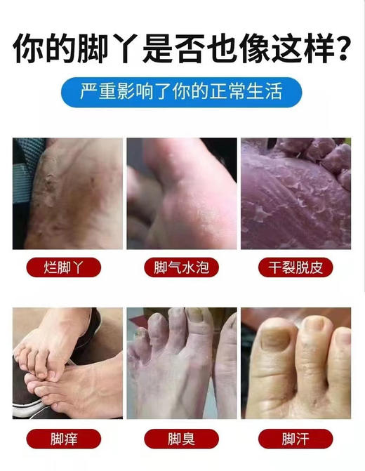 【SDBFC藏药脚气膏】一抹终结脚丫烂、痒、臭..安全高效不复发!! 抑菌率高达99.9%!!藏yao配方纯天然安全一抹见效 商品图4