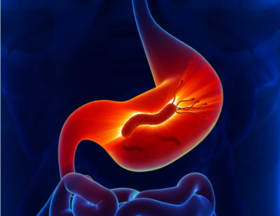 幽门螺杆菌阳性，到底治不治？有关幽门螺杆菌，你不可不知的10大真相