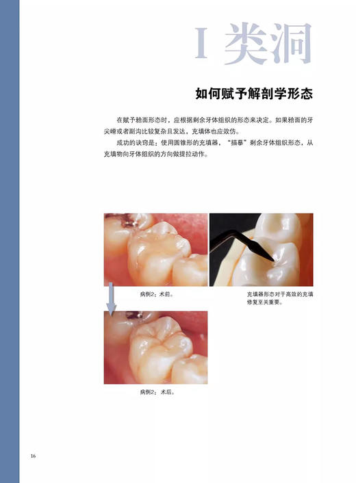 复合树脂修复的科学与技术 改订版 张泓灏 主译口腔牙齿种植修复学复合树脂充填技术前牙复杂病例树脂修复要点 9787559136626 商品图3