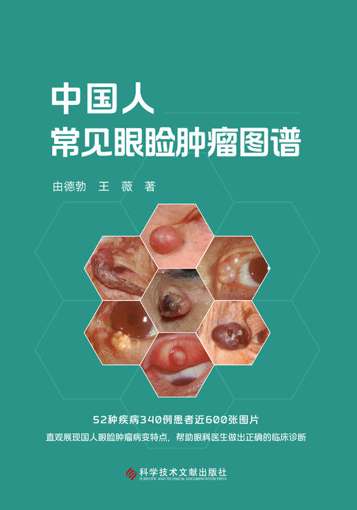 中国人常见眼睑肿瘤图谱 由德勃 王薇主编 商品图1