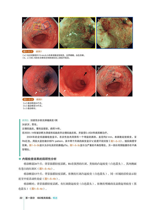 炎症性肠病相关肠癌内镜图谱 大肠与小肠的内镜检查图像 日松井敏幸 等著 虞伟明 许丰 译 辽宁科学技术出版社9787559134295  商品图3