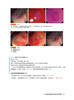炎症性肠病相关肠癌内镜图谱 大肠与小肠的内镜检查图像 日松井敏幸 等著 虞伟明 许丰 译 辽宁科学技术出版社9787559134295  商品缩略图4