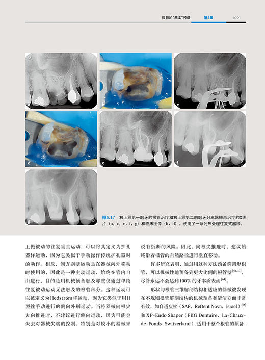 根管清理与成形 喻刚主译 口腔治疗 牙体牙髓 根管解剖 根管治疗器械 根管预备步骤根尖预备成形 辽宁科学技术出版社9787559134172 商品图3