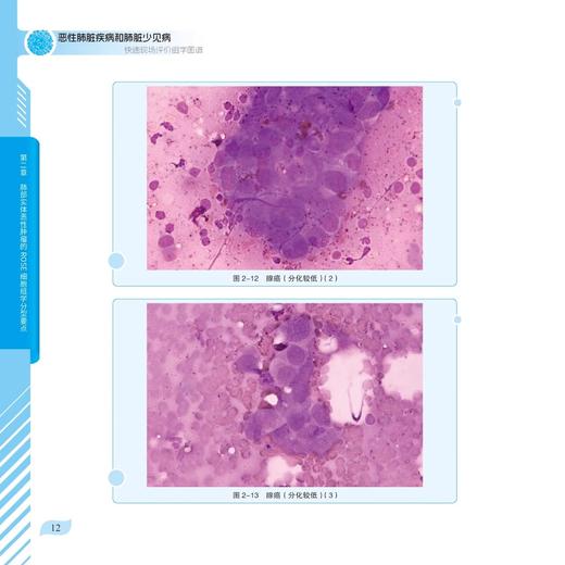 恶行肺脏疾病和肺脏少见病快速现场评价组学图谱 细胞及其成分径线增加 主编冯靖 靳芳 植丽佳 科学技术文献出版社9787523514702 商品图4