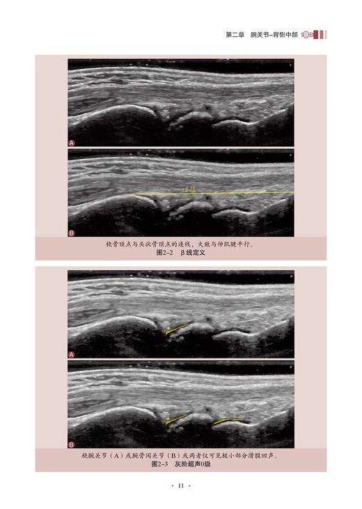 关节滑膜炎超声图谱 关节炎症的超声量化评分系统 滑膜炎灰阶超声评分规则 主译丁红 蔡叶华 科学技术文献出版社9787523514870 商品图4