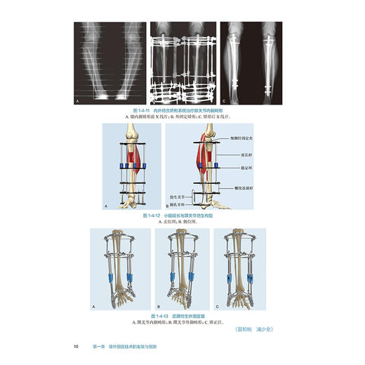 实用骨外固定学 第2版附增值 骨外固定在矫正脑性瘫痪下肢畸形中的应用 主编 夏和桃 秦泗河 张云峰 人民卫生出版社9787117364409 商品图4