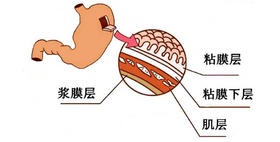  解读一下胃病