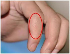  手上长这种透明小水泡？那是身体向你发出的求救信号！ 