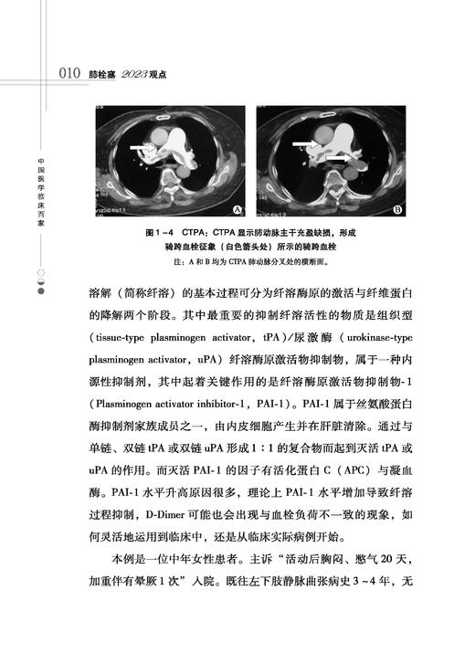 肺栓塞2023观点 警惕陷阱及早诊断 PTE概念及其危险分层的知道意义 防控结合三化统一 主编米玉红科学技术文献出版社9787518999507 商品图4