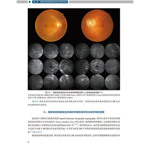 图说糖尿病视网膜病变 图说眼科系列 糖尿病与糖尿病眼部并发症 糖尿病视网膜病变的发病机制 张新媛 人民卫生出版社9787117358873 商品图4