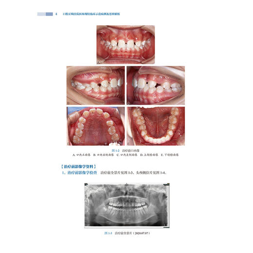 口腔正畸住院医师规培临床示范病例及思辨解析 骨性类均角青少年埋伏牙牵引矫治 青少年拔牙矫治 房兵人民卫生出版社9787117365758 商品图4