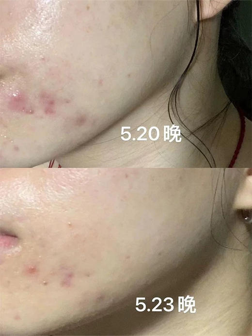 痘敏肌王老吉！芙清凉茶次抛清痘舒缓精华液5支（26.11） 商品图3