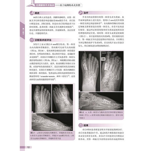 足踝翻修手术挑战基于病例的术式介绍 应用双钢板配合髓内克氏针翻修移位的跖骨头截骨 术科学技术文献出版社 9787523515471 商品图2