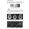 神经内科疑难罕见病例诊疗思路 中枢神经系统炎性疾病 神经系统感染 自身免疫相 主编王金涛等 辽宁科学技术出版社9787559137296 商品缩略图4