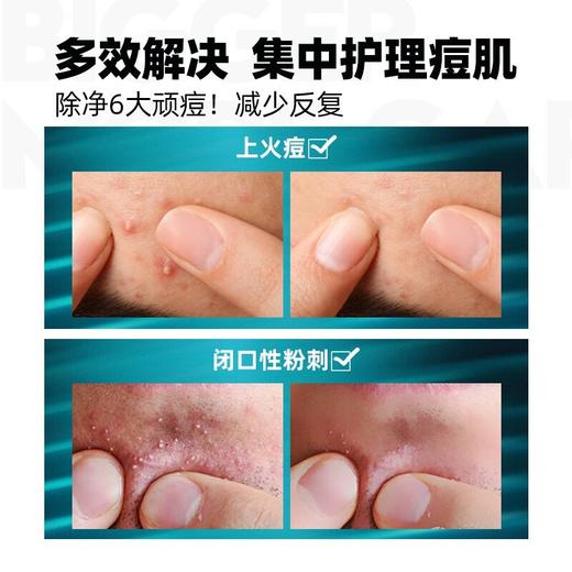 左颜右色 祛痘膏 10g 商品图2