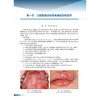 口腔黏膜病药物治疗精解第2版 口腔黏馴唢感染性疾病的药物治疗 球菌性口炎 坏死性龈口炎 主编周红梅人民卫生出版社9787117365840 商品缩略图4