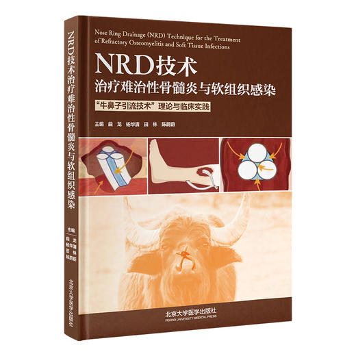 NRD 技术治疗难治性骨髓炎与软组织感染——“牛鼻子引流技术”理论与临床实践    曲龙 杨华清 田林 陈蔚蔚 主编   北医社 商品图0