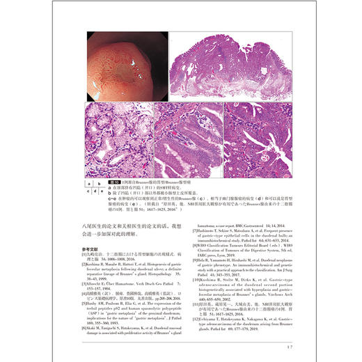 胃与肠 十二指肠非乳头区腺瘤和腺癌的诊断和治疗 日本 胃与肠编委会 编著 消化内镜 辽宁科学技术出版社9787559136619 商品图4