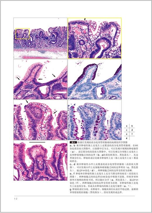 胃与肠 幽门螺杆菌除菌后发现胃癌的诊断进展 胃与肠翻译委员会译  X线诊断 消化内科内镜技术 辽宁科学技术出版社9787559134820 商品图4
