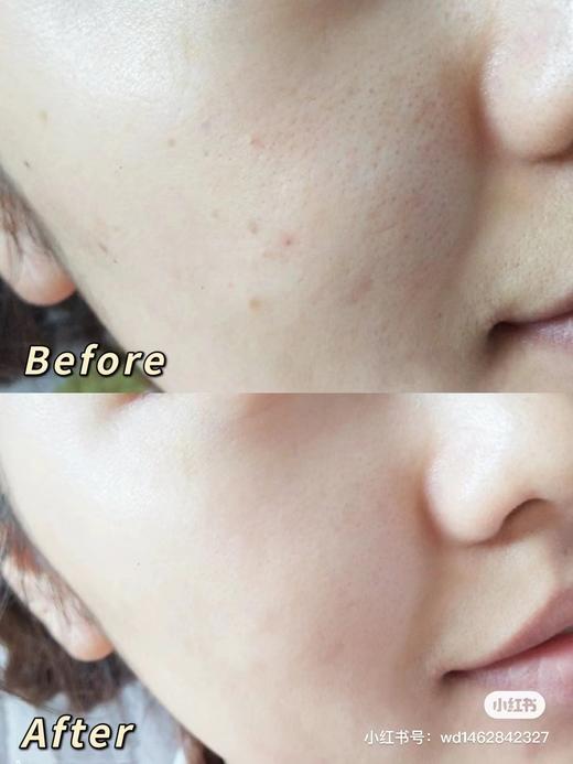 【清仓好价】果敢果酸冻干精华进阶组（精华液7ml+冻干絮0.1g）*5组（效期至24.11） 商品图2