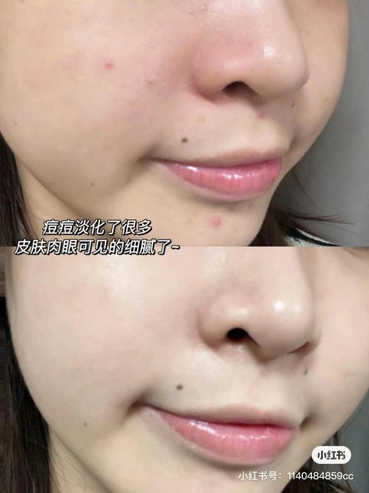 【清仓好价】果敢果酸冻干精华进阶组（精华液7ml+冻干絮0.1g）*5组（效期至24.11） 商品图1