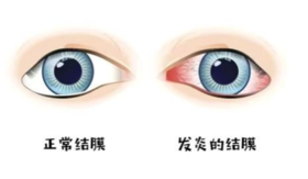 一换季孩子眼就红痒、还总揉！过敏性结膜炎该如何应对？