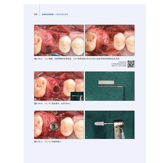 生物导向骨增量骨柱与骨片技术 配视频 常晓龙 骨柱与骨片技术的理论基础病例生物学口腔种植学辽宁科学技术出版社9787559135599  商品图4