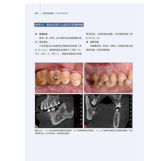 生物导向骨增量骨柱与骨片技术 配视频 常晓龙 骨柱与骨片技术的理论基础病例生物学口腔种植学辽宁科学技术出版社9787559135599  商品图3